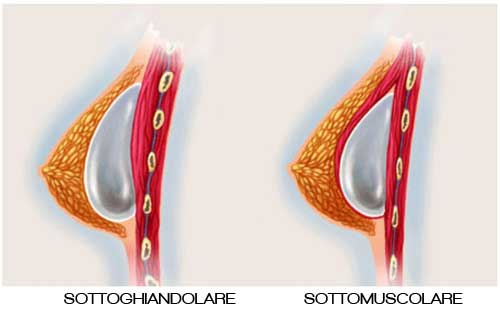 mastoplastica additiva sottomuscolare vs mastoplastica additiva sottoghiandolare